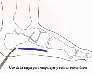 Fascitis Plantar/Espolón del Calcáneo