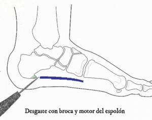 Fascitis Plantar/Espolón del Calcáneo